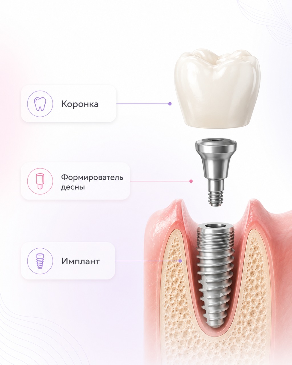Имплант Straumann SLA — коронка, формирователь десны, имплант
